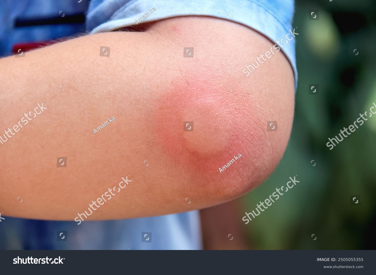 stock-photo-sunburn-redness-of-the-nose-young-woman-worried-about-her-red-skin-of-the-nose-isolated-on-white-2430635243