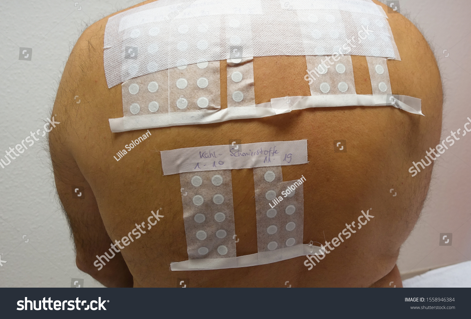 stock-photo-skin-allergy-patch-test-on-back-of-male-patient-german-inscription-translation-k-hl-und-1558946384